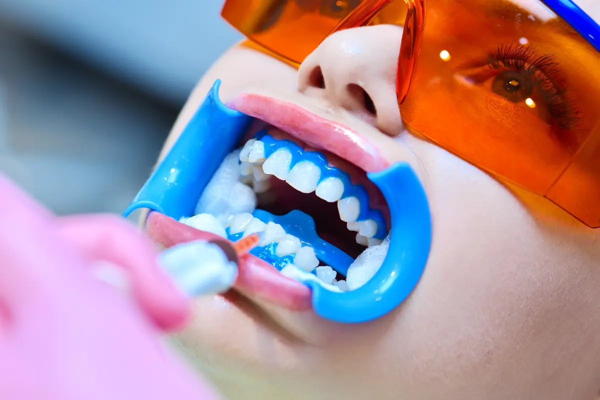Clareamento Dental a Laser Cuidados Essenciais