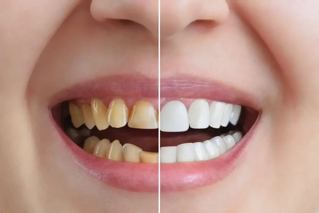Clareamento dental antes e depois
