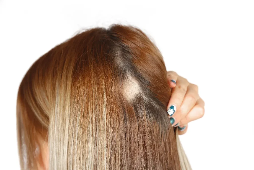 Mulher segurando uma parte do cabelo, mostrando a alopécia