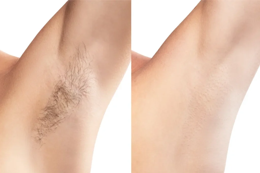 Antes e depois da depilação a laser nas axilas