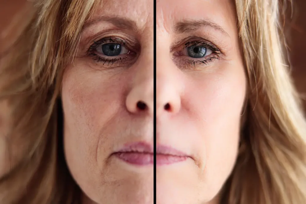 Antes e depois do Botox