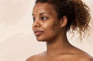 Melasma 7 Dicas Para Controlar e Reduzir as Manchas - Mulher negra com melasma no rosto