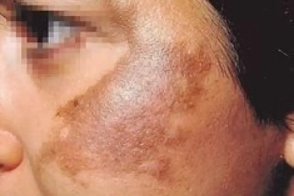 Melasma no rosto