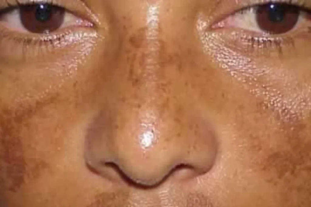 Mulher com melasma no nariz e na bochecha