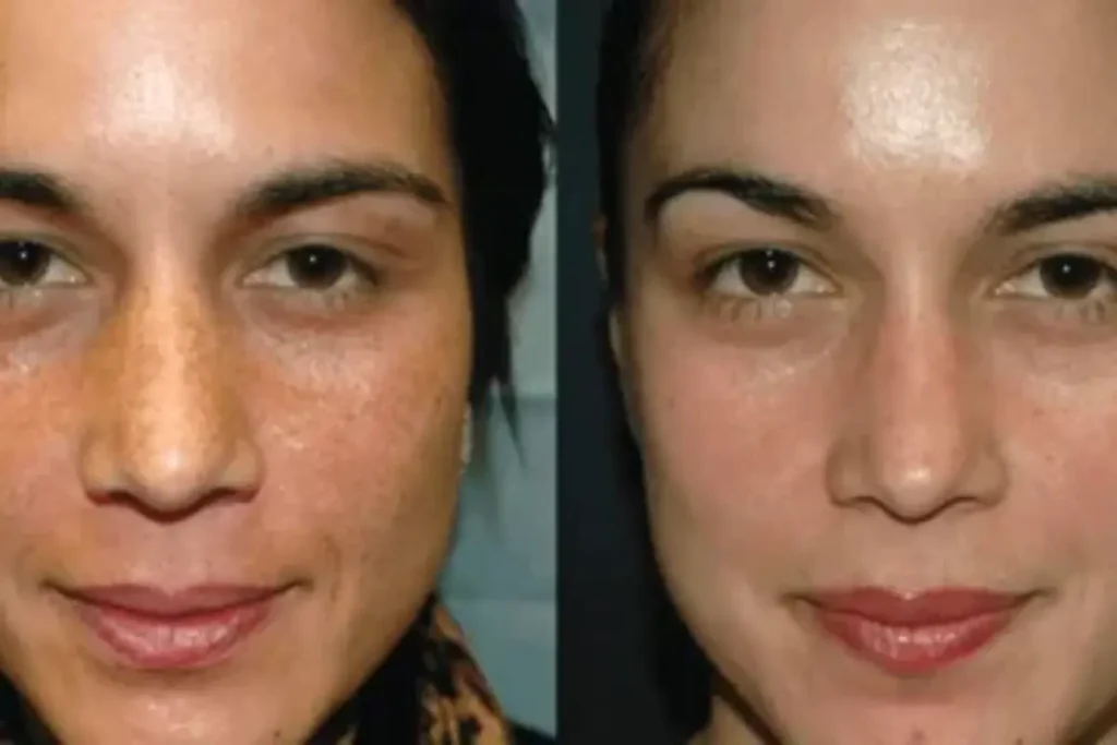 Mulher com melasma no rosto, antes e depois de tratamento