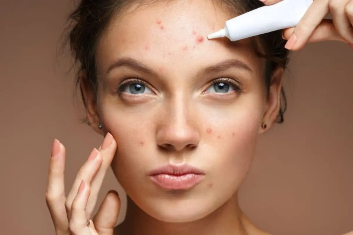 8 Dicas Infalíveis de Tratamentos Para Acne que Você Precisa Conhecer - Mulher aplicando remédio as espinhas