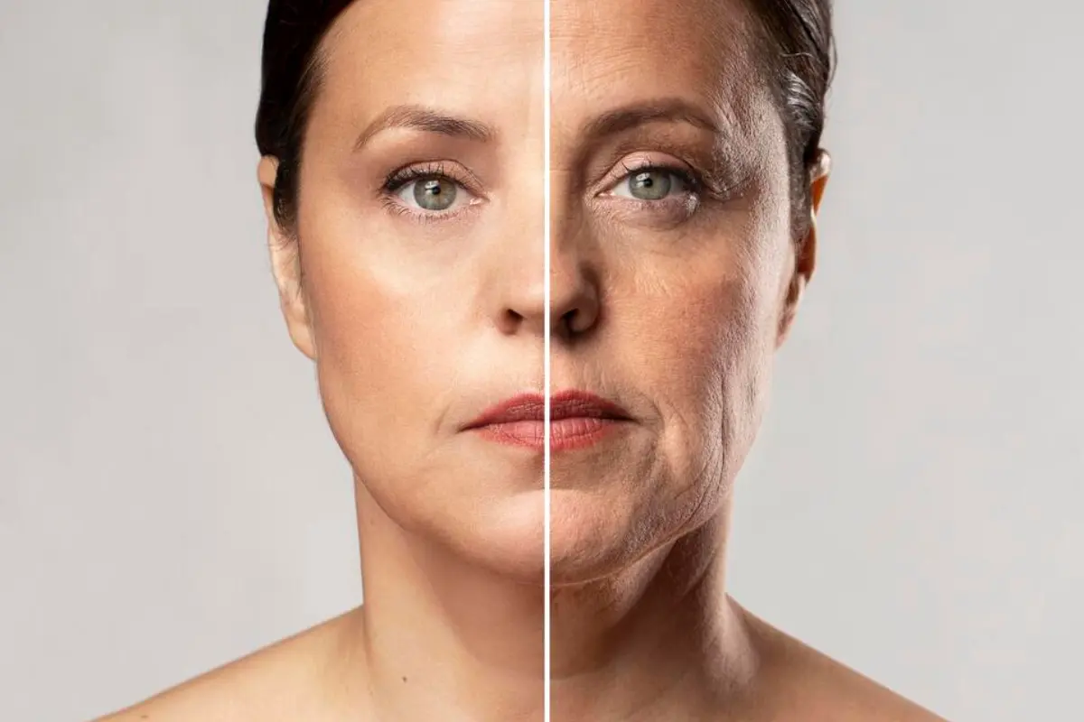 Benefícios Top 6 do Lifting Facial - Mulher antes e depois de Lifting Facial