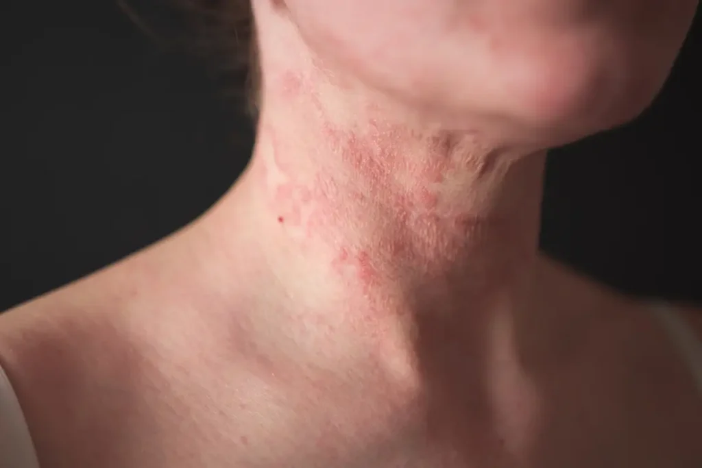 Mulher com dermatite no pescoço