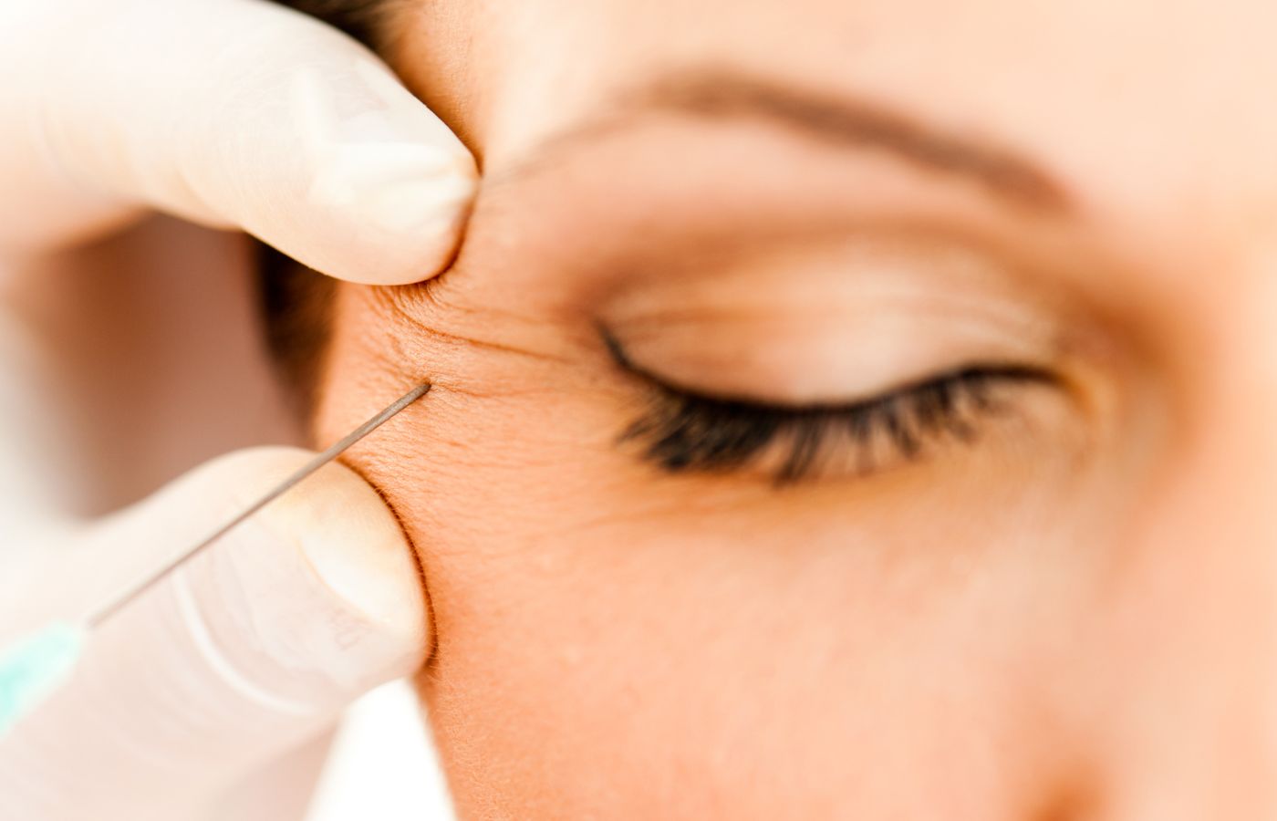 Microbotox 7 Benefícios Que Vão Surpreender Você - Mulher numa sessão de microbotox na região perto dos olhos