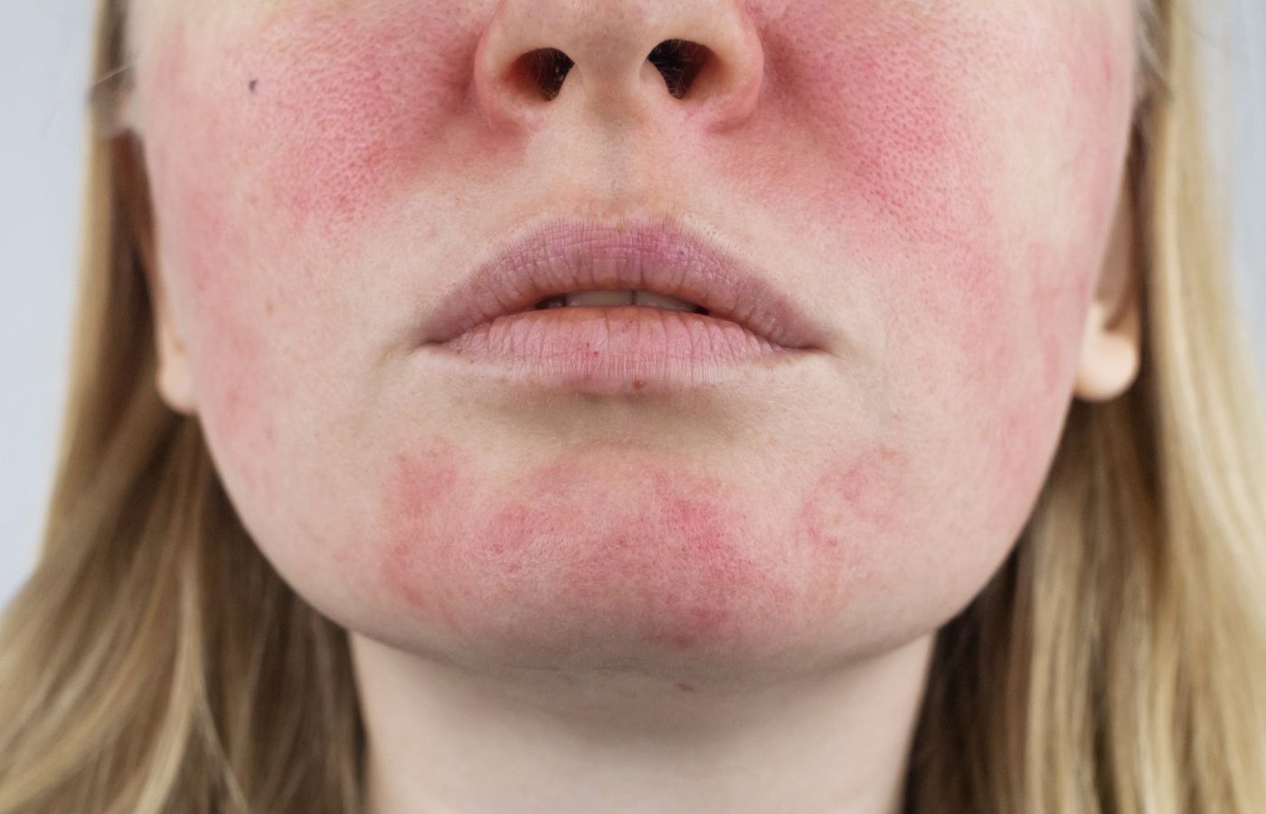 Mulher com rosáceas na pele do rosto