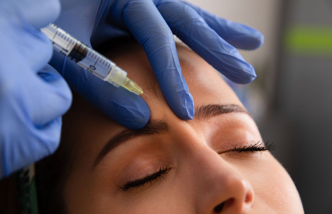 Mulher numa sessão de microbotox sendo aplicada entre as sobrancelhas